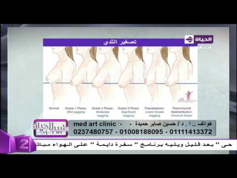 مراحل ترهلات الثدي عند السيدات