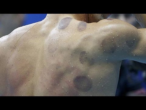 الحجامة تخطف الأضواء في أولمبياد البرازيل