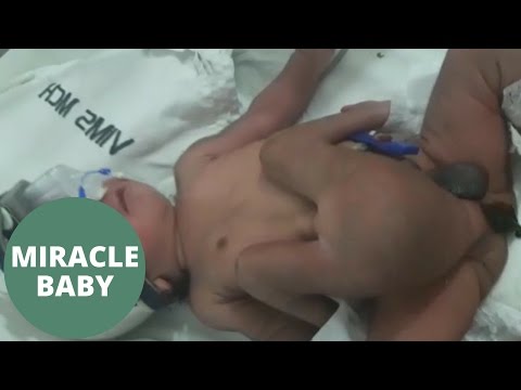 شاهد ولادة طفل بأربعة أرجل وعضوان تناسليان