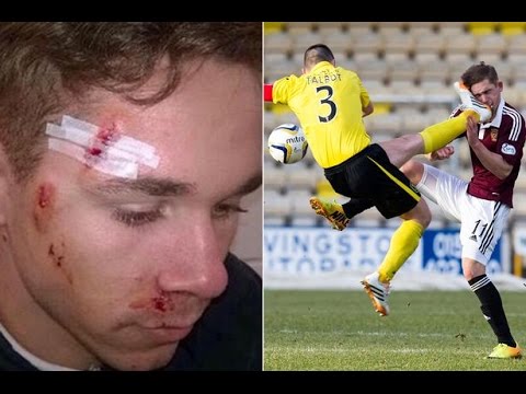 ضرب الاسكتلندي سام نيكولسون في وجهه