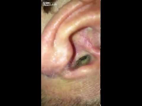 شاهد رجل يكتشف حشرة غريبة داخل أذنه