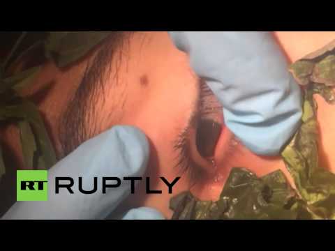 بالفيديو الأطباء يعملون على سحب دودة من عين شاب