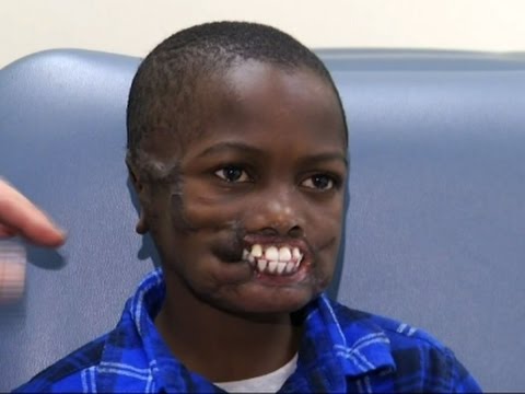 by chimps to undergo facial surgery